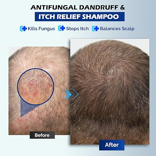 Miniatura 5 de Champú anticaspa y antifúngico, para dermatitis seborreica, foliculitis, psoriasis del cuero cabelludo, alivia la picazón del cuero cabelludo, la