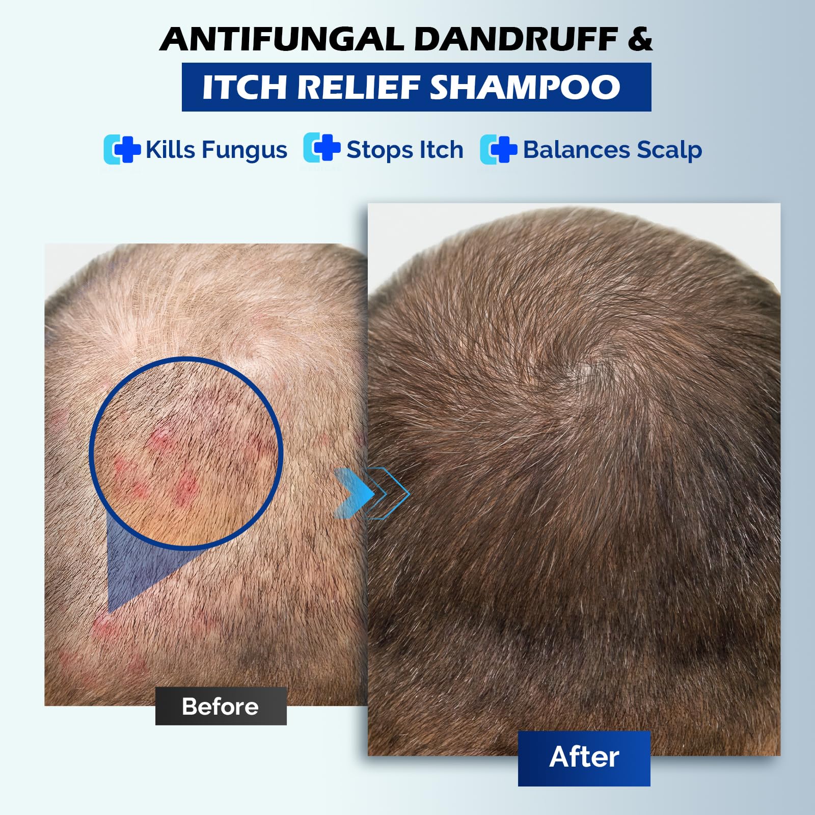 Champú antifúngico para dermatitis seborreica, foliculitis y psoriasis del cuero cabelludo, champú anticaspa para hombres y mujeres, alivia la picazón del cuero cabelludo, la sequedad, sin sulfatos ni 5