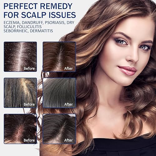 Miniatura 6 de Sin sulfato  Champú de tratamiento de foliculitis antifúngica con fórmula para propenso a la foliculitis, dermatitis seborreica, para cuero