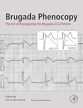 Brugada Phenocopy: The Art of Recognizing the Brugada ECG Pattern