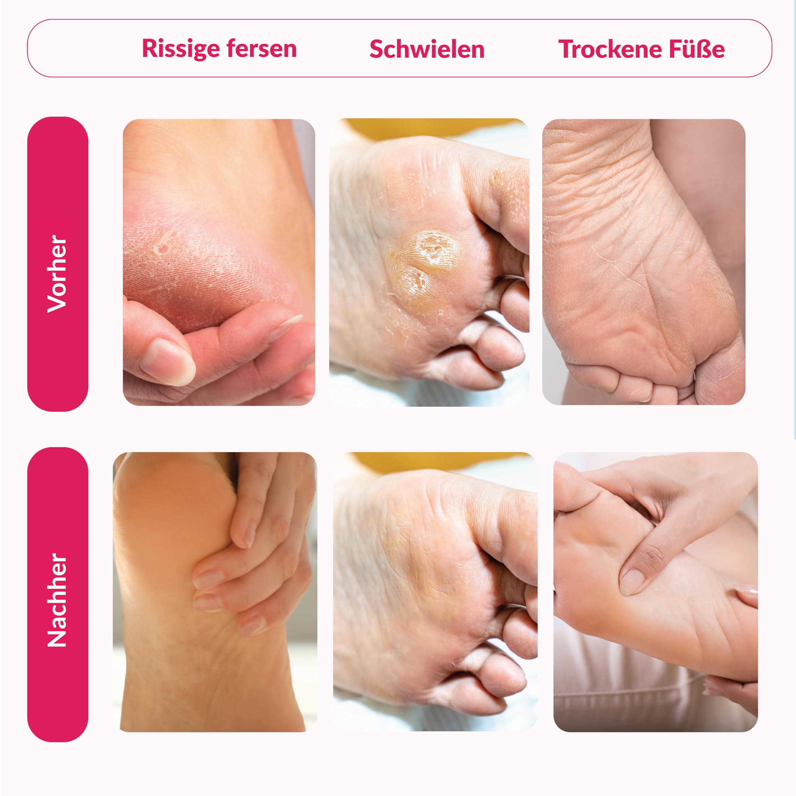 Summer Foot 2 paires de chaussettes anti-callosités premium - masque pour callosités - masque pour pieds doux - soins des pieds efficaces - testé dermatologiquement