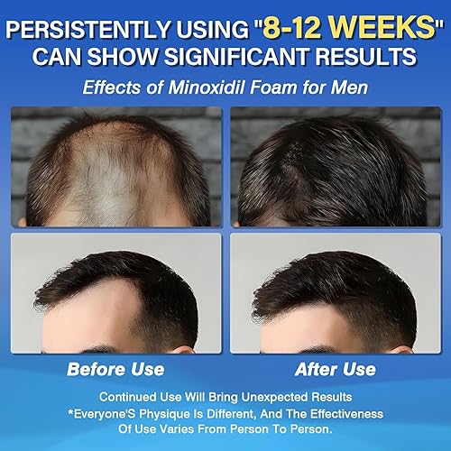 Miniatura 2 de Minoxidil 5% de espuma para el crecimiento del cabello para hombres, adecuada para adelgazamiento del cabello, línea capilar y pérdida de cabello a