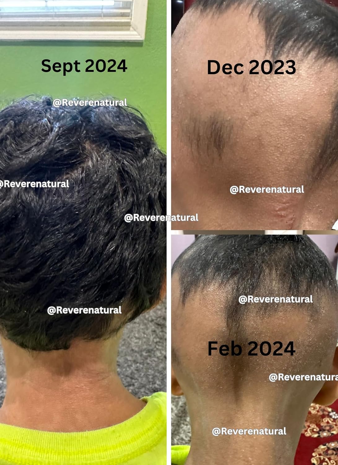 Handcrafted Scalp Oil – For thinning hair from PCOS, hormonal shifts, postpartum & medical hair loss, seborrheic dermatitis – Coconut, Rosemary, Fenugreek & Black Seed – 2oz, Made in CA