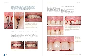 Nonsurgical Periodontal Therapy: Indications, Limits, and