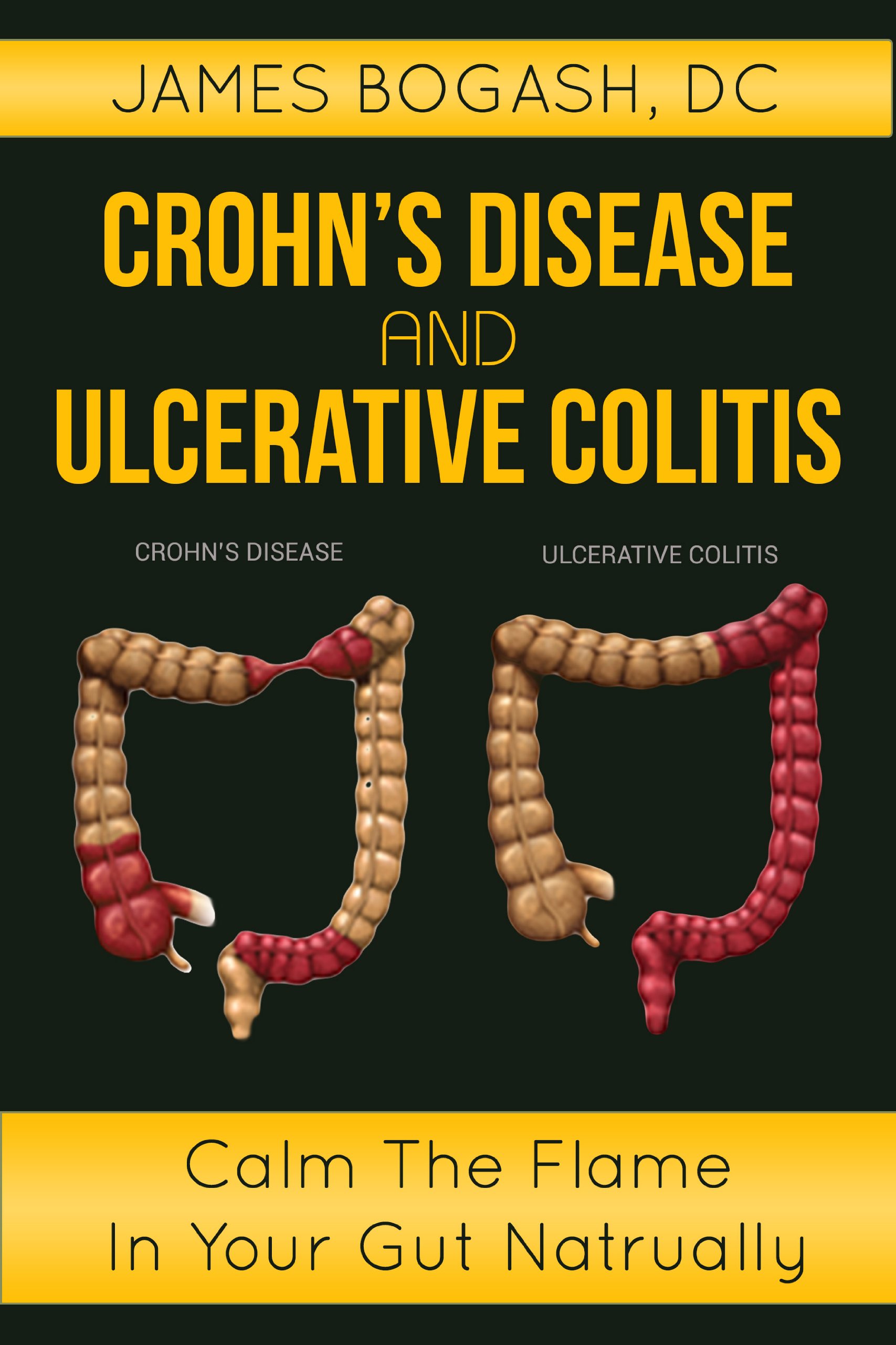 Crohns Disease and Ulcerative Colitis: Calm the Flame in Your Gut Naturally