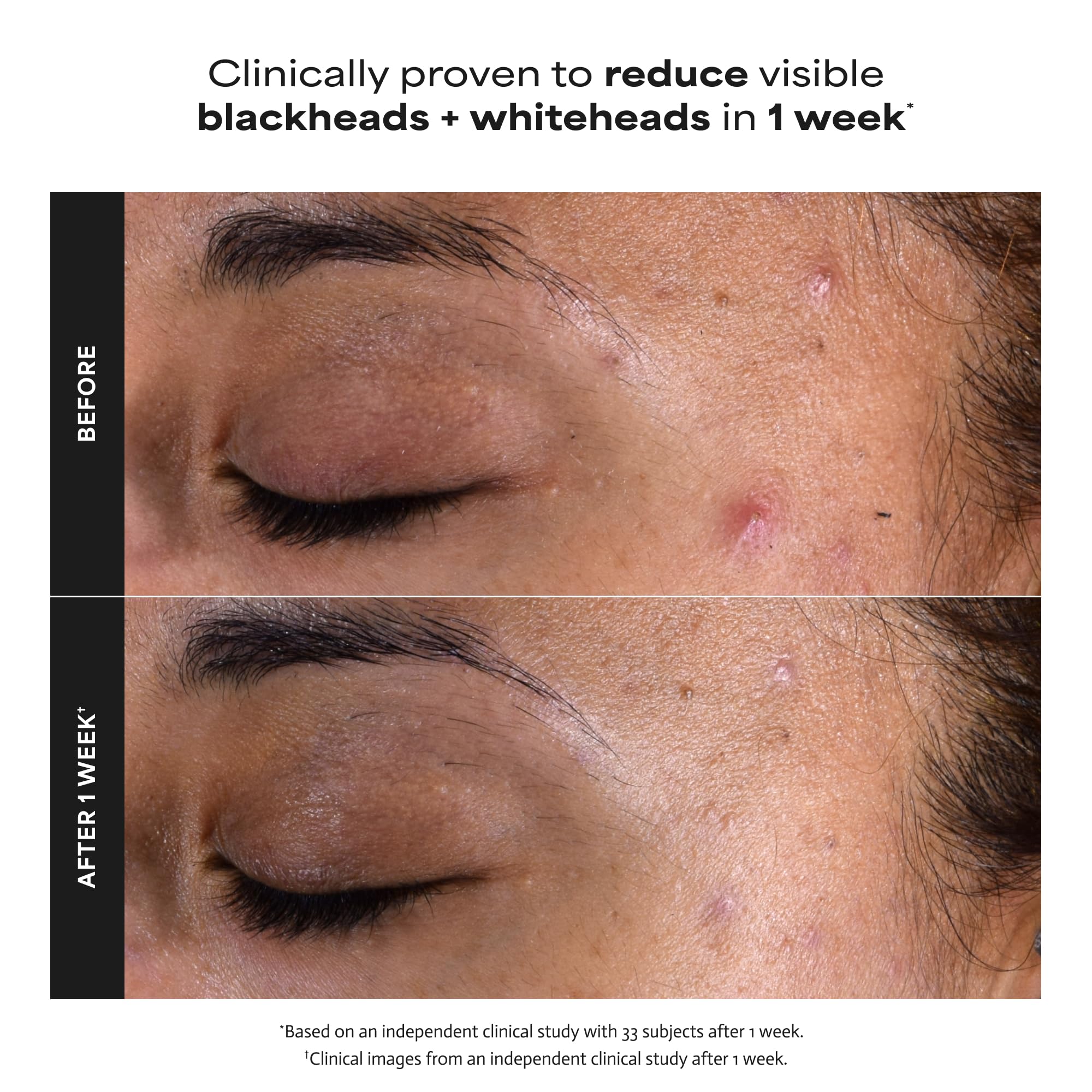 Paula's Choice SKIN PERFECTING 2% BHA Esfoliante Liquido - Peeling Viso con Acido Salicilico - Combatte Imperfezioni, Punti Neri & Brufoli - Ridurre i Pori - Pelli Miste o Grasse - 30 ml