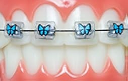 Snapcaps Braces Bumper Cover, Orthodontic Bracket Wax Substitute, Alternative Snap-on Braces Guard Braces Accessories 10 pack (Butterfly)