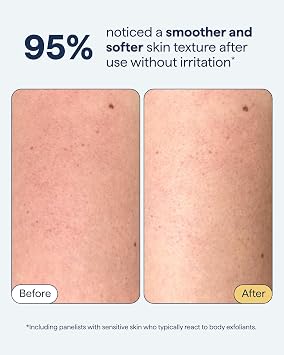 Remedy KP Duo Exfoliating Body Scrub and Moisturizer for Smoother Skin | Keratosis Pilaris and Chicken Skin | Glycolic Acid, Retinol, Urea, Ceramides | By Dermatologist Dr. Shah | 6.8 + 7.7 fl oz