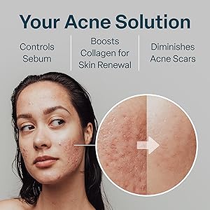 Don't Miss Out Acne Skin Care Tips 2 81elDDF45FL. SL300