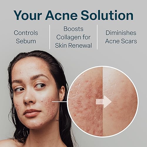 Miniatura 4 de Almohadillas de control de acné 102 de ácido glicólicosalicílico con ácido glicólico ultra puro  2 de ácido salicílico alantoína vitaminas B5 C y E