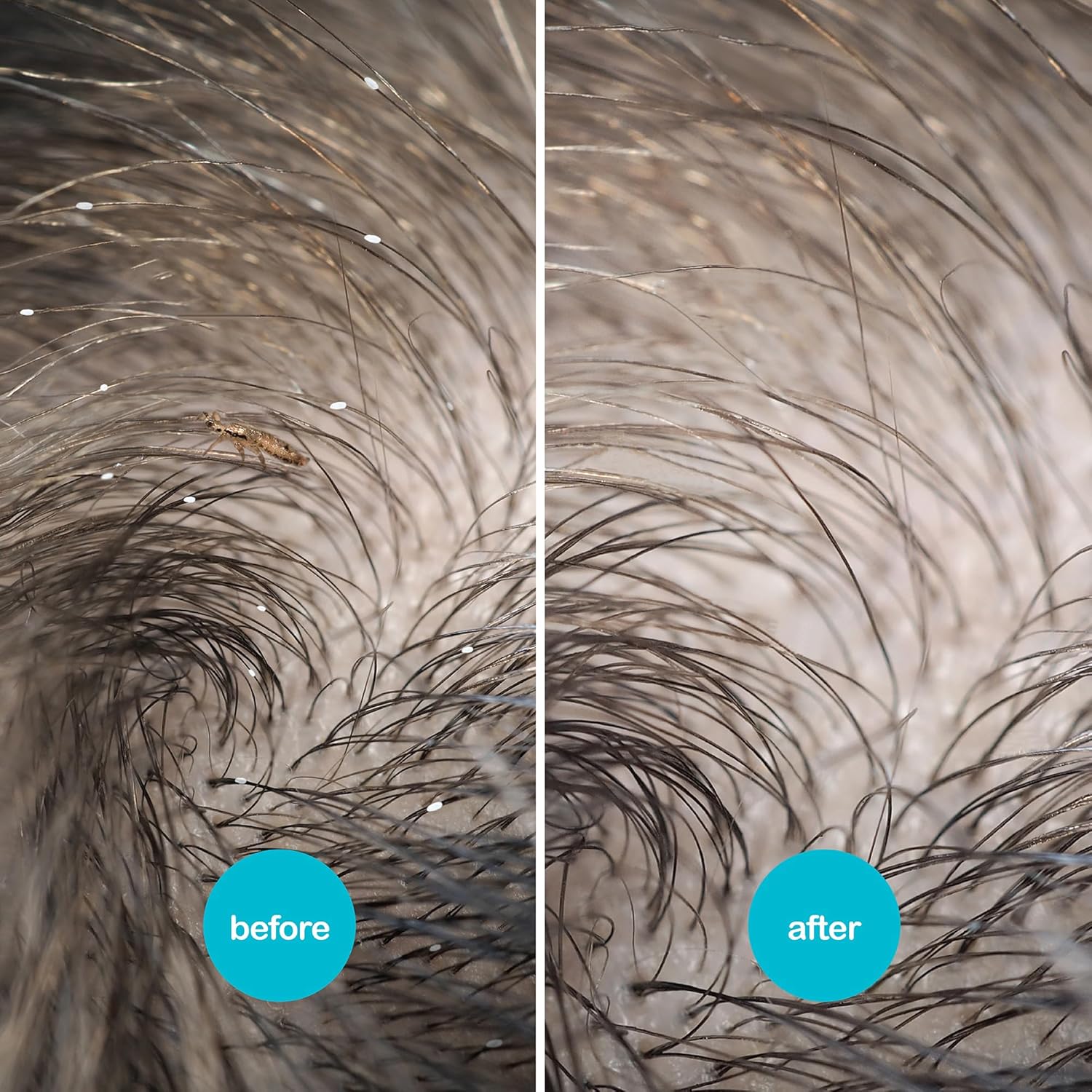 NitWits Head Lice & Egg Comb 2 Pack, 3-in-1 Lice Comb, Detangles, Removes Lice & Eggs and Includes 5x Magnifying Glass