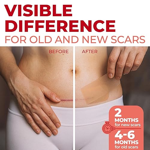 Miniatura 2 de Hojas de silicona de grado médico para cicatrices – Paquete de 6 unidades (7 x 1.6 pulgadas) – Diferencia visible en cicatrices de cesárea – Hojas