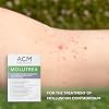 Molutrex Molluscum Treatment 3ml