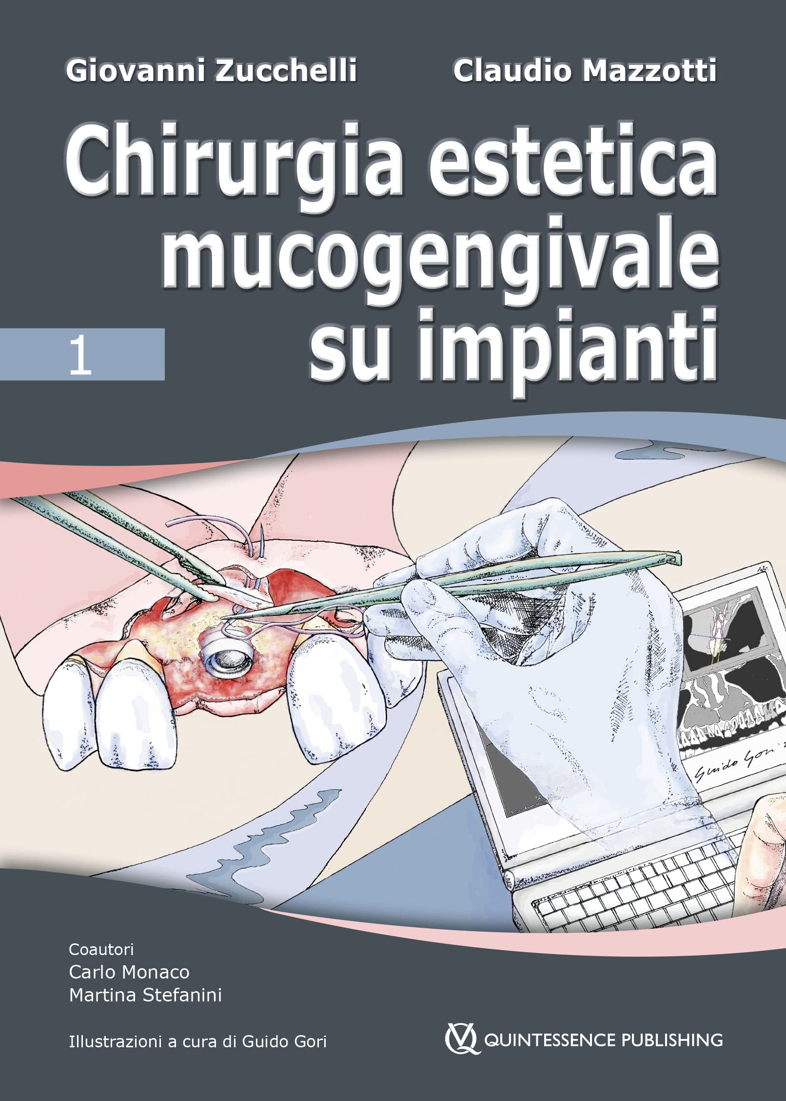 Chirurgia estetica mucogengivale su impianti