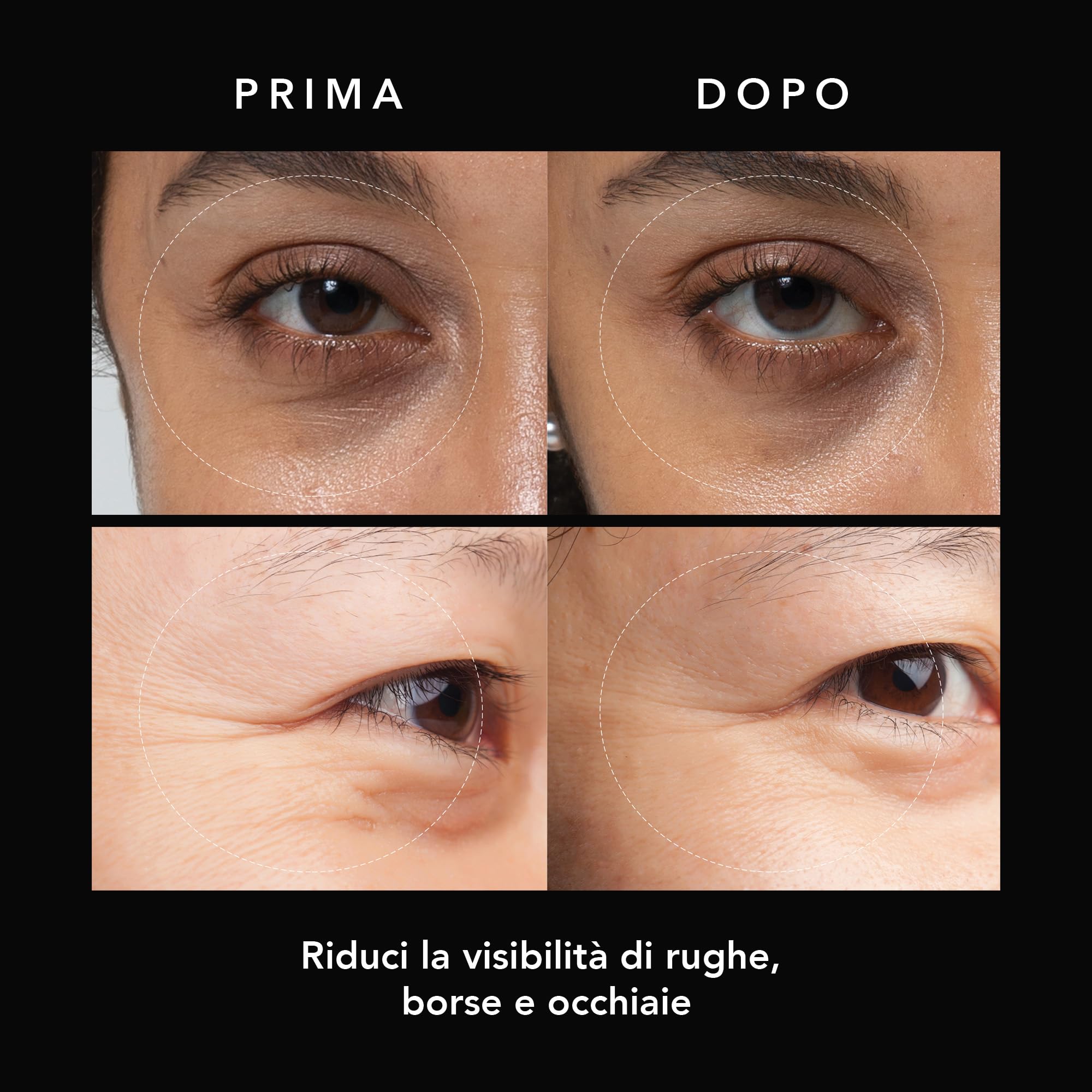 FAQ Microneedling Anti-Wrinkle Hyaluronic Acid Patches For Under Eyes - Under Eye Mask - Anti Wrinkle Patches - Instant Non-invasive Results - Travel-friendly - 3x2 pcs.