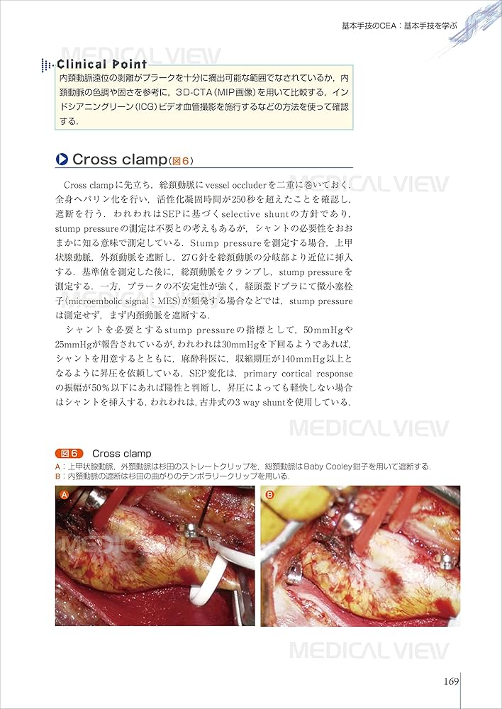 パーフェクトマスター 頚動脈狭窄症 | 永田 泉, 中原 一郎 |本 | 通販