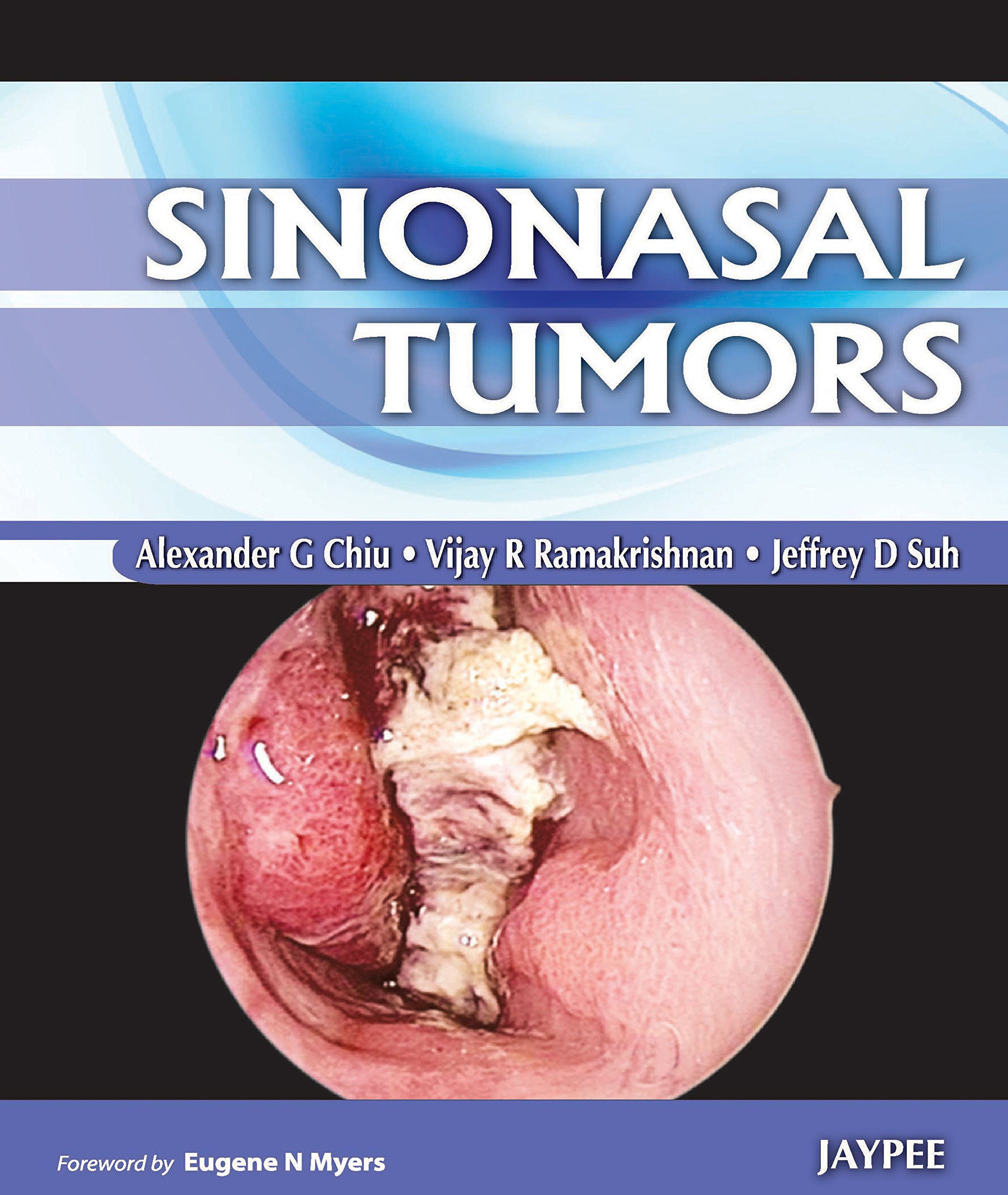Sinonasal Tumors (English Edition)