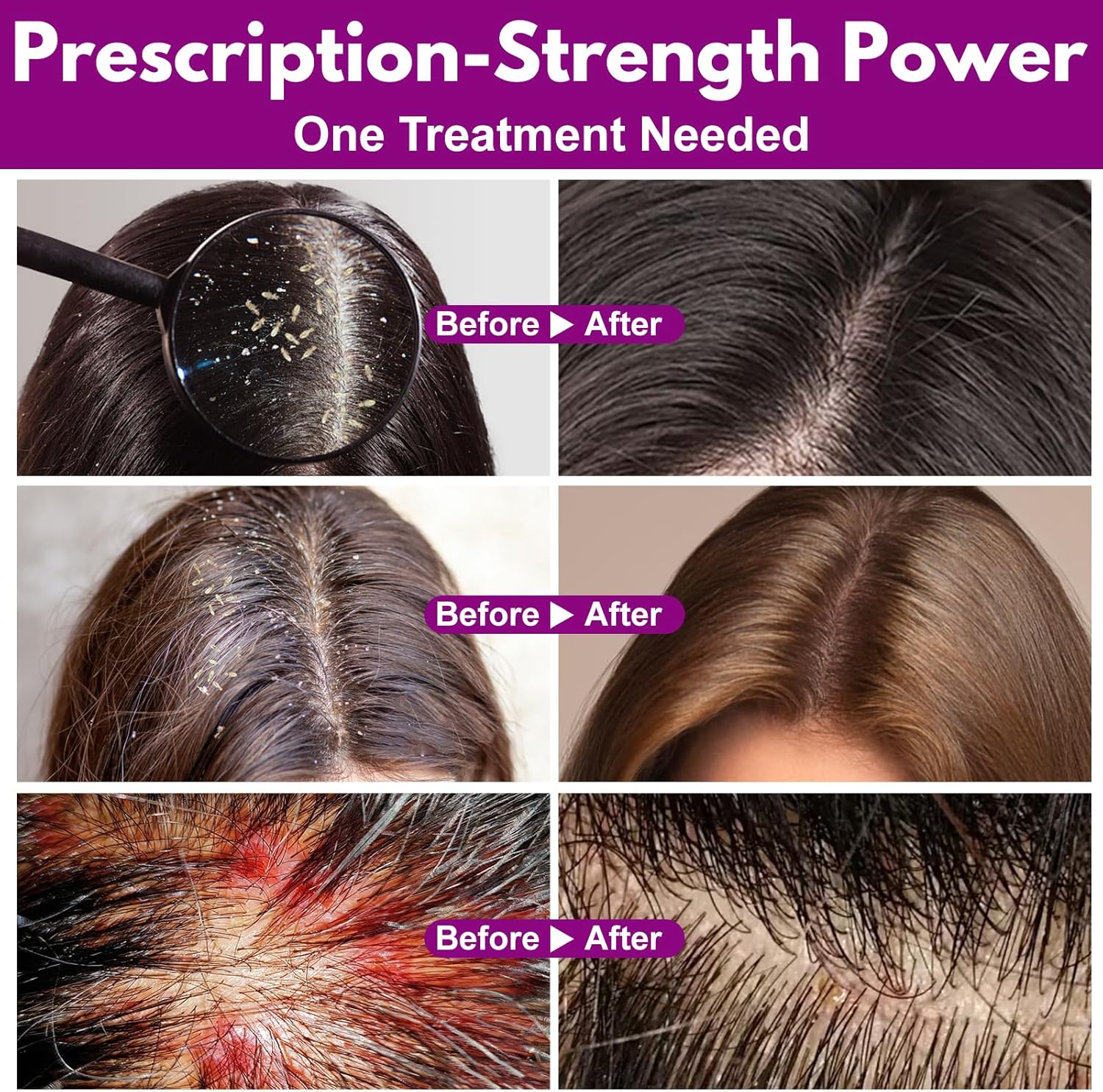 Ivermectin 0.5% Lotion for Head Lice Treatment – Prescription-Strength Ivermectin Lotion for Super Lice & Their Eggs – No Combing, 10-Minute Application, Gentle on Scalp, Safe for Kids, 2 oz - Image 3