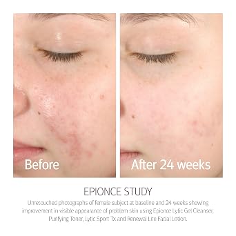 Epionce Purifying Toner - Face & Body Blemish & Blackhead Clarifying Toner