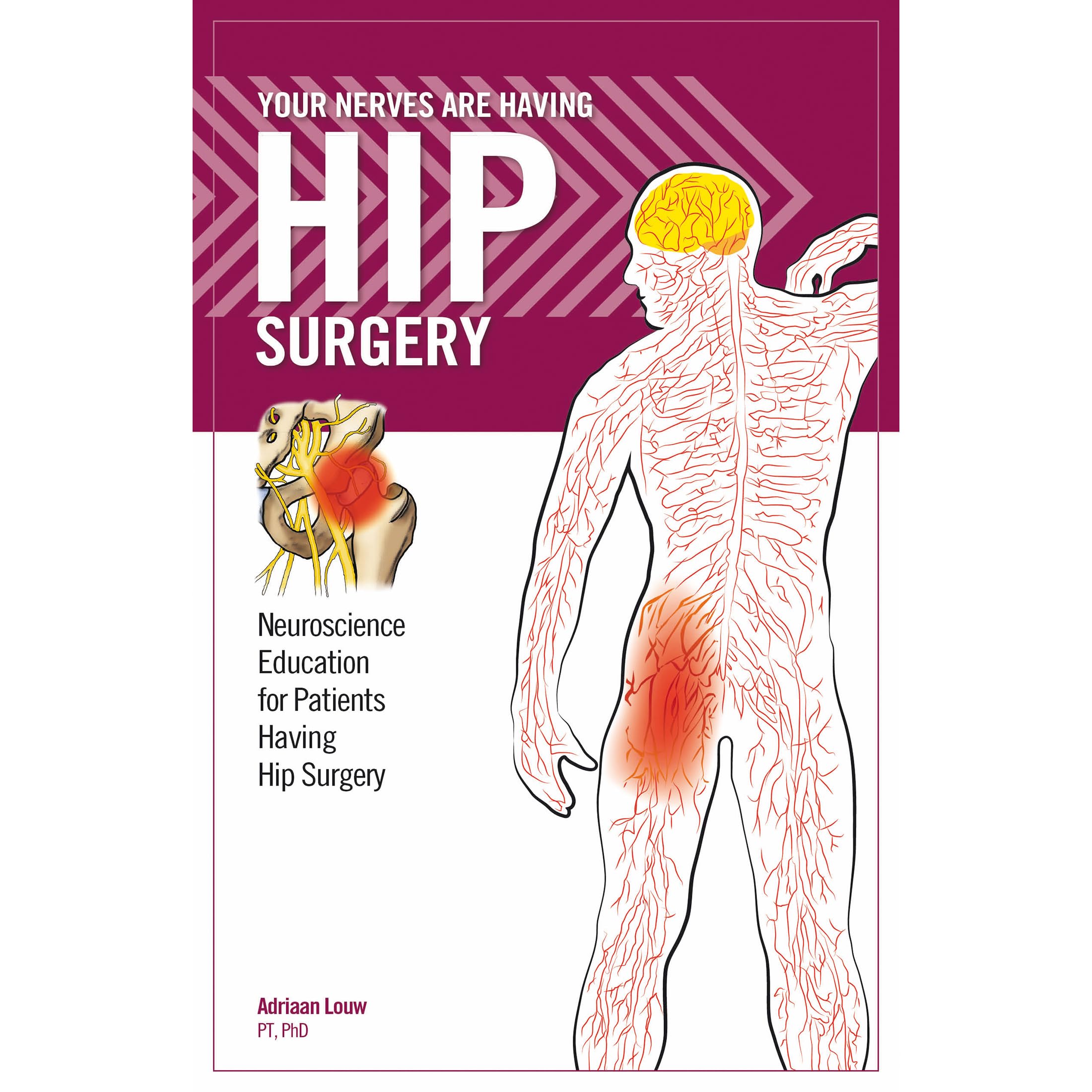 Your Nerves Are Having Hip Surgery (8757) Paperback – 1 April 2018