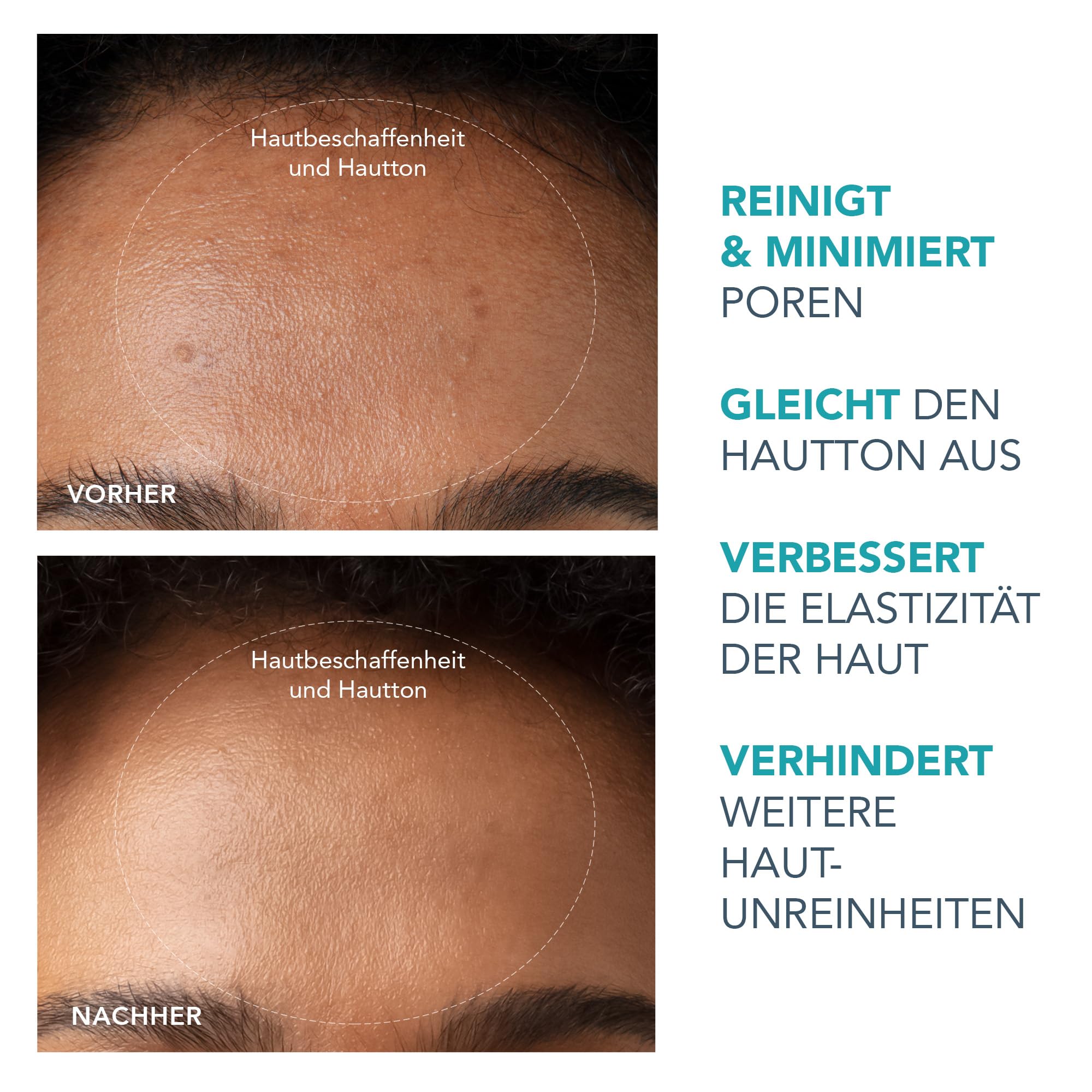 KIWI Mitesserentferner + KIWI Active Pore & Blackhead Mask 100 g Set | Mitesserentferner, Porensauger, Mitessersauger, Porenverfeinerer, Extraktor, Gesichtsmaske, Porenreiniger, Komedonen