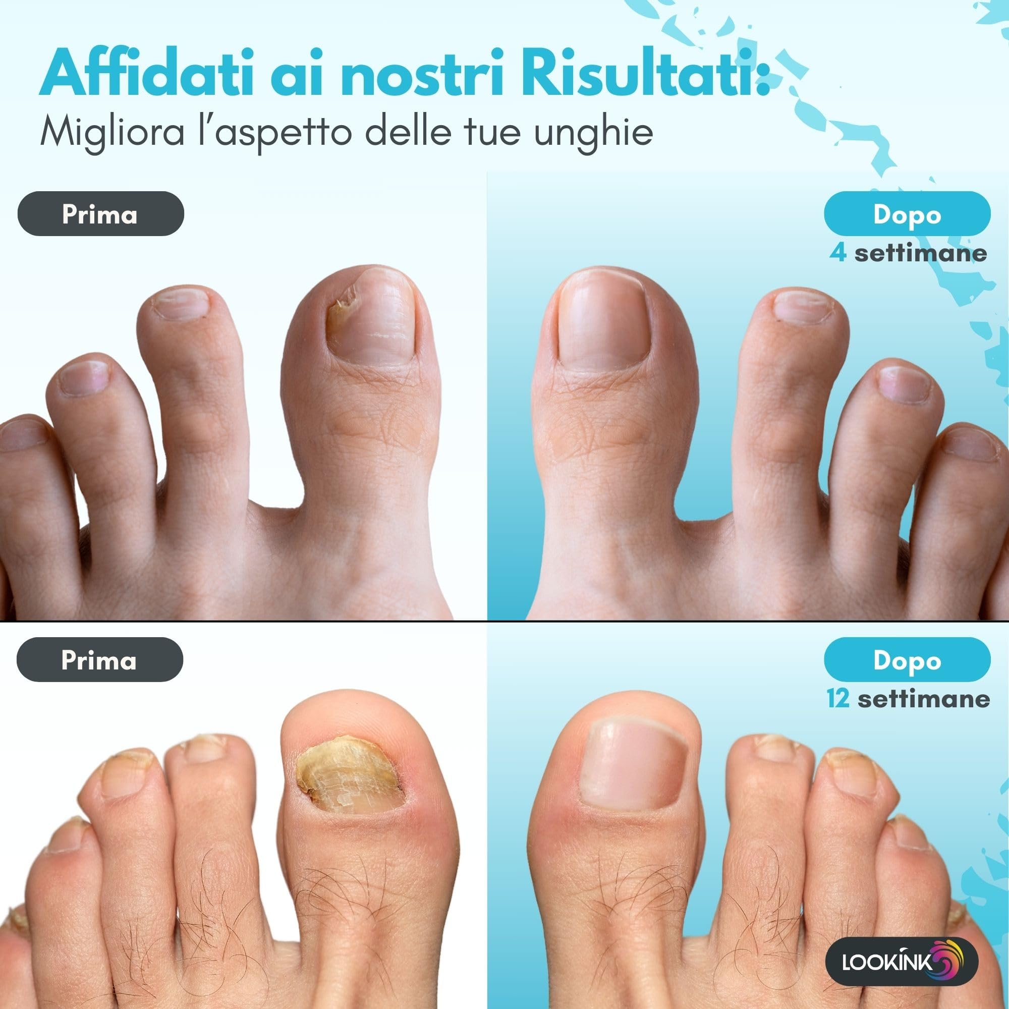 Smalto per Micosi Unghie Piedi e Mani 12 ml - Made in Italy - Trattamento Antimicotico Forte Smalto ideale per Funghi e Onicomicosi - Trattamento Efficace Per la Ricrescita di Unghie Sane