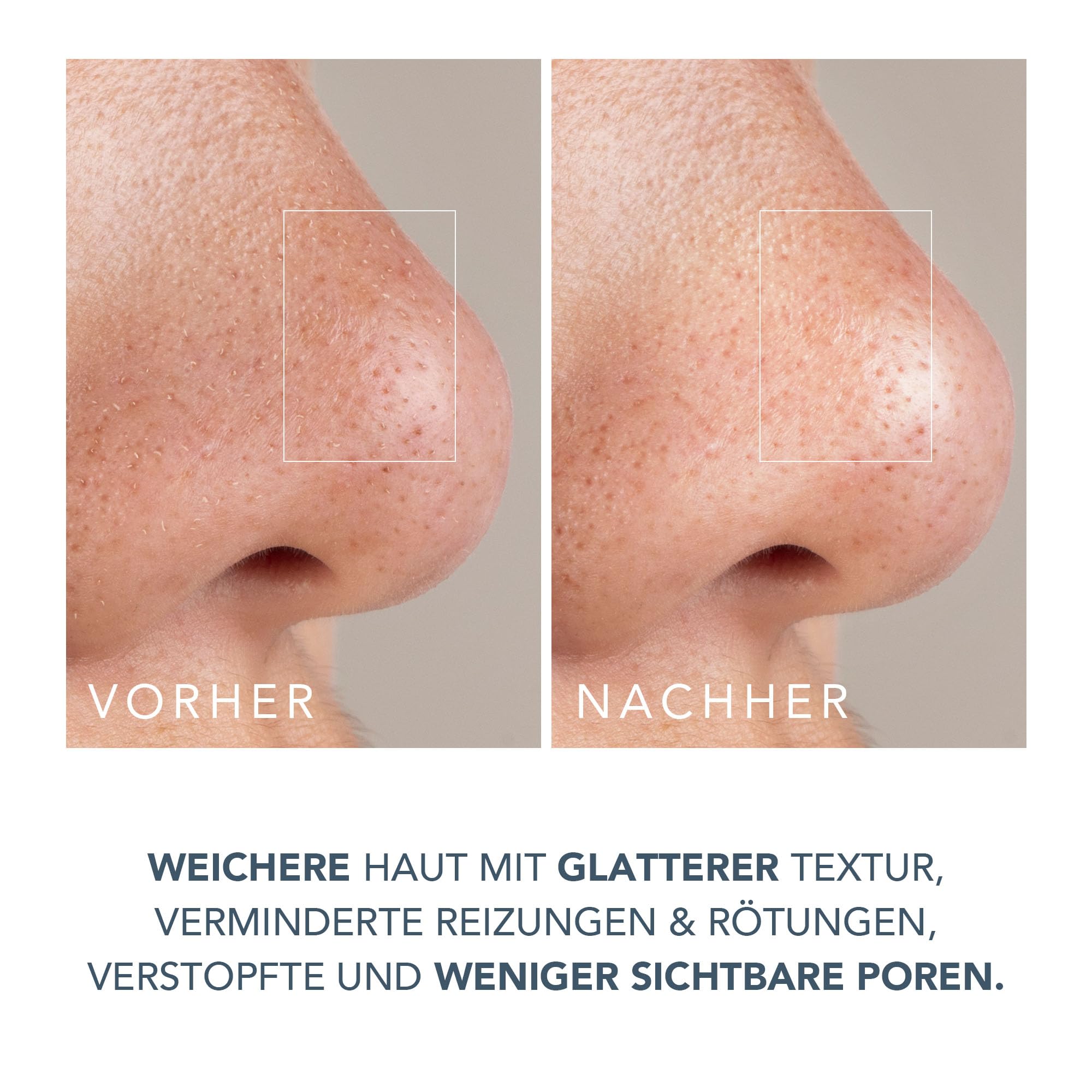 FOREO Smooth & Resurface KIWI derma Mikrodermabrasionsgerät - Mitesserentferner fürs Gesicht + KIWI™ Active Pore & Blackhead Maske, 100 g - Mitesserentferner - Tschüss-Poren-Strips-Porensauger