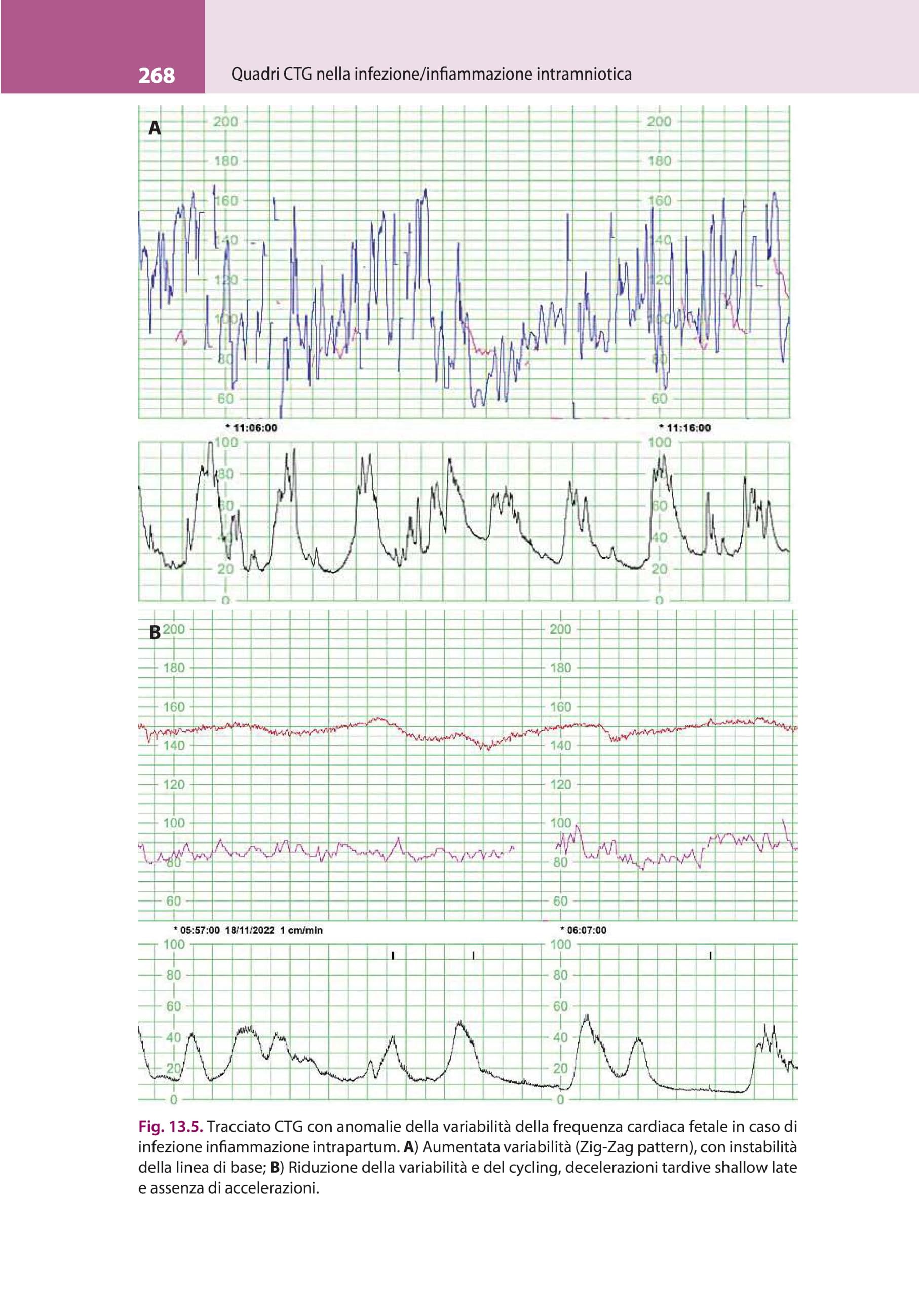 La lettura fisiopatologica della cardiotocografia intrapartum