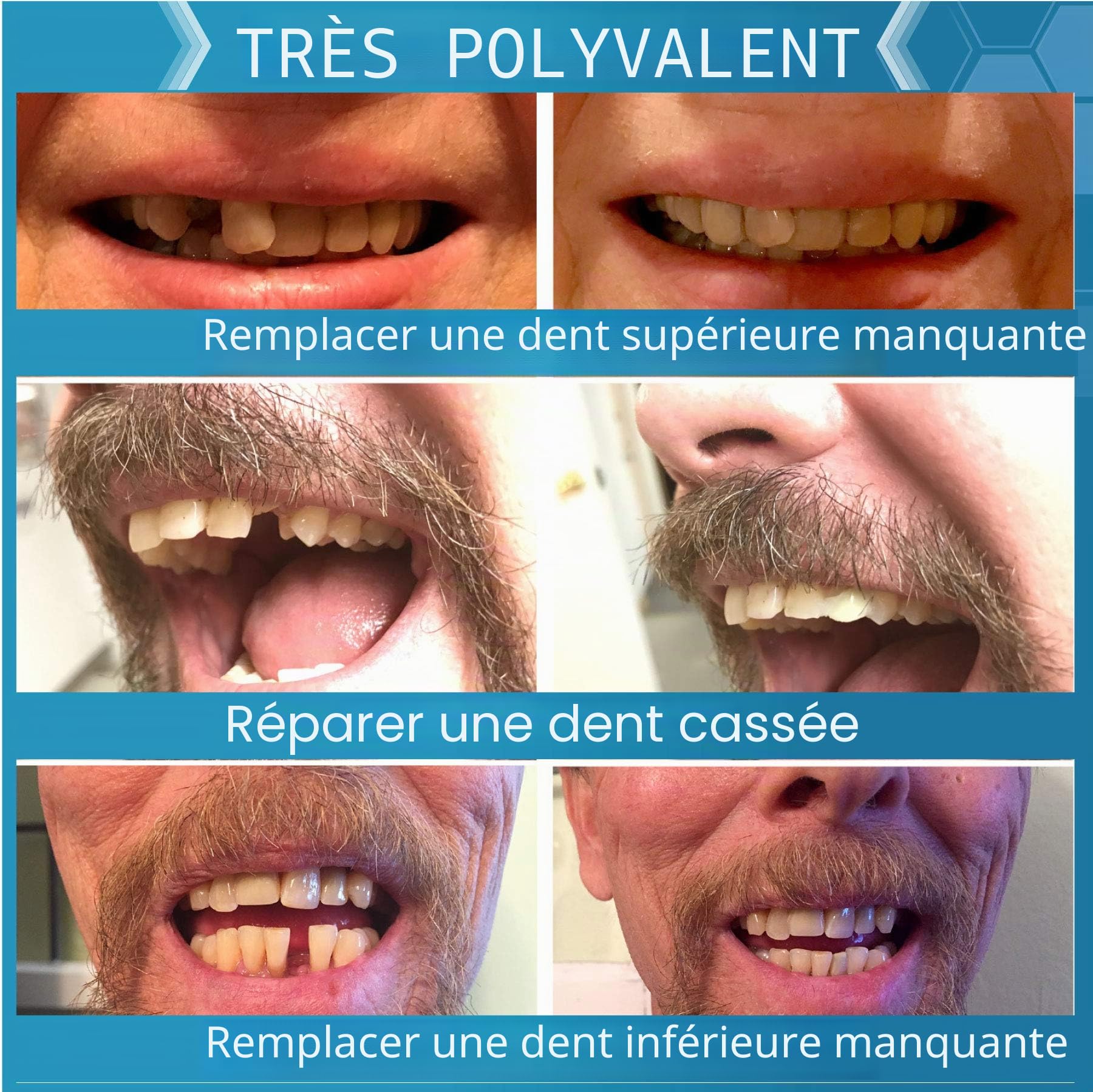 Instant Smile Complétez Votre Sourire Temporary Dental Replacement Kit – Kit Dentaire de Remplacement, Facile à Utiliser, Sourire Instantané, Taille Unique