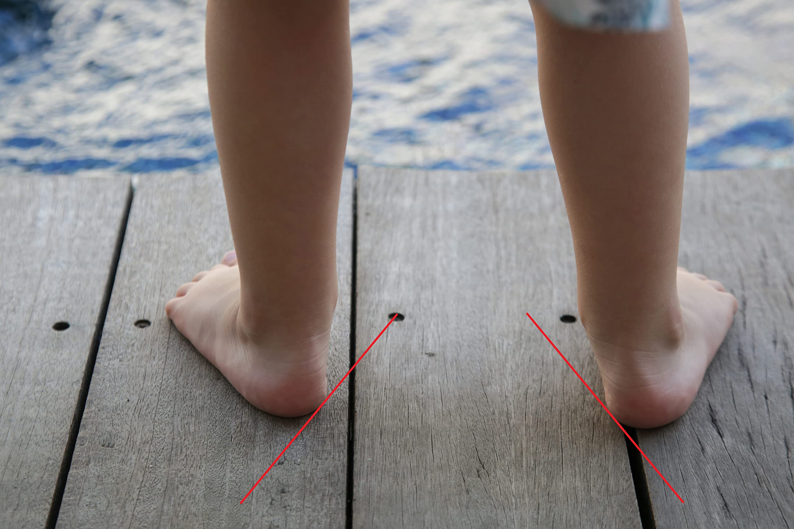 KINGMED Plantillas Supinadoras para Mujeres para Pronación de Rodilla y Talón Valgo Plantilla Ortopédica con Soporte de Arco Metatarsal Cubierta Genuina de Piel de Cabra 1 Par x 2Pcs 37