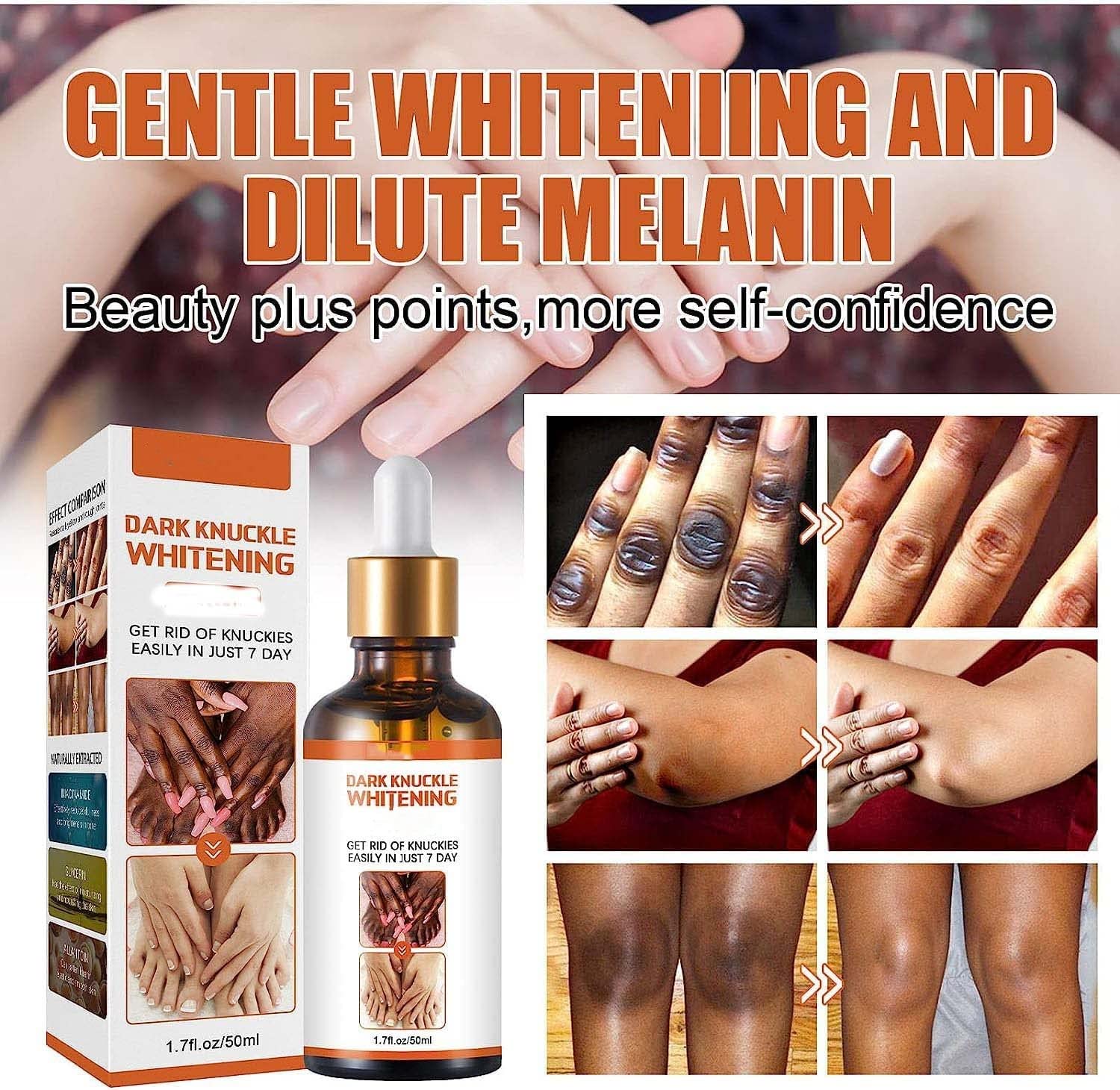 Acanthosis Nigricans Therapy Oil, Dark Spot Corrector Oil, Acanthosis Nigricans Treatment, Dark Spot Remover Lighten Body Black Skin, Removing Dark Knuckle Finger Elbow (2pcs)
