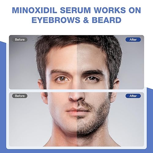 Miniatura 7 de Suero de crecimiento capilar con minoxidil al 5% con biotina para hombres y mujeres, promueve un cabello más grueso y saludable, minoxidil tópico