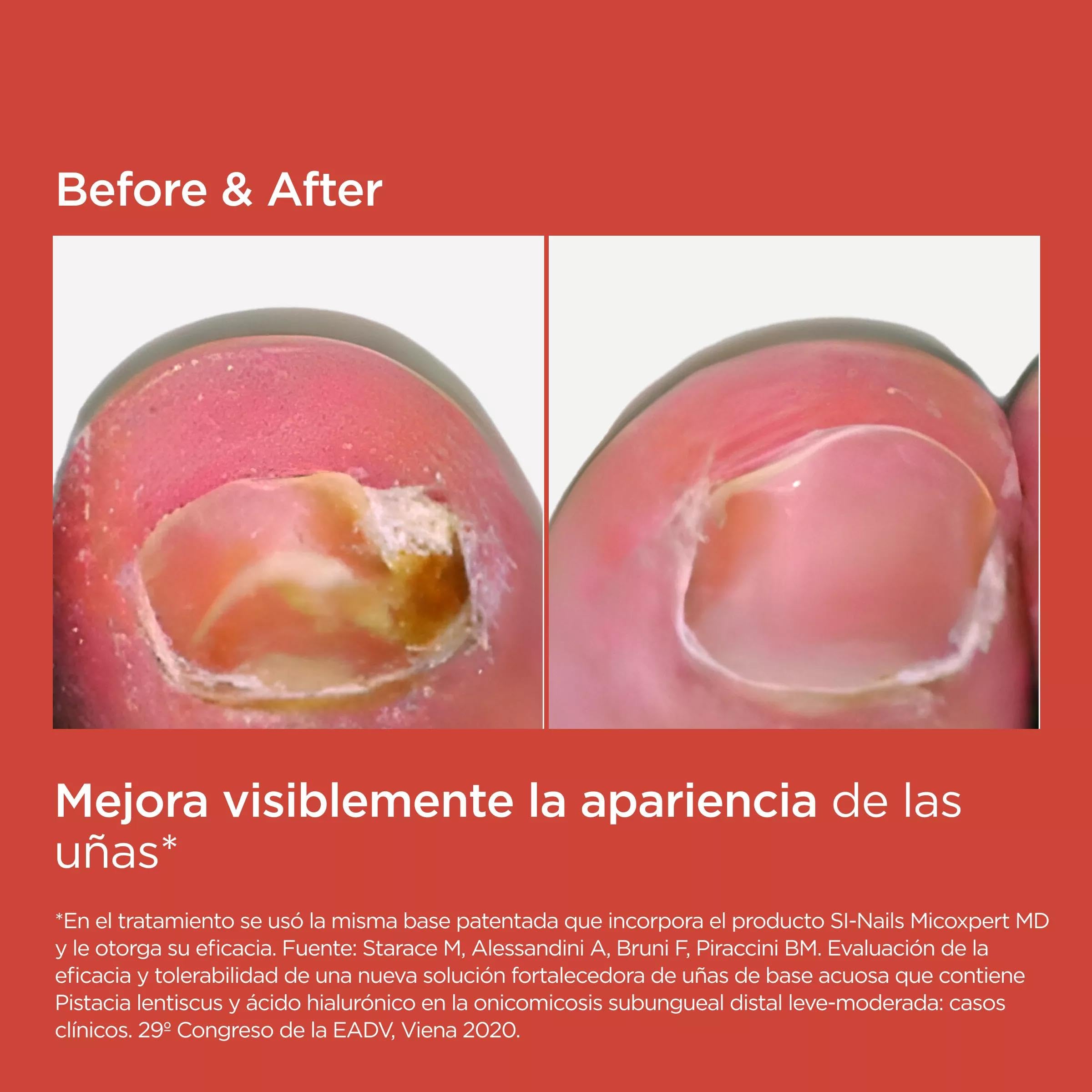 ISDIN SI-NAILS MICOXPERT MD, para el tratamiento y la prevención de infecciones fúngicas leves o moderadas en uñas de manos y pies, 4,5ml
