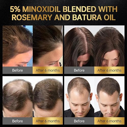Miniatura 3 de Minoxidil para hombres y mujeres, con biotina, aceite de batana, aceite esencial de romero, solución eficaz para la pérdida de cabello, tratamiento