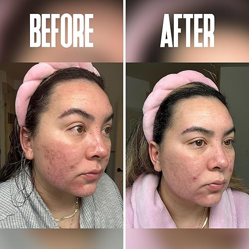 Miniatura 6 de Juego de cuidado de la piel antienvejecimiento pela de ácido glicólico al 60% y almohadillas de rejuvenecimiento glicólico. Este dúo ultra potente