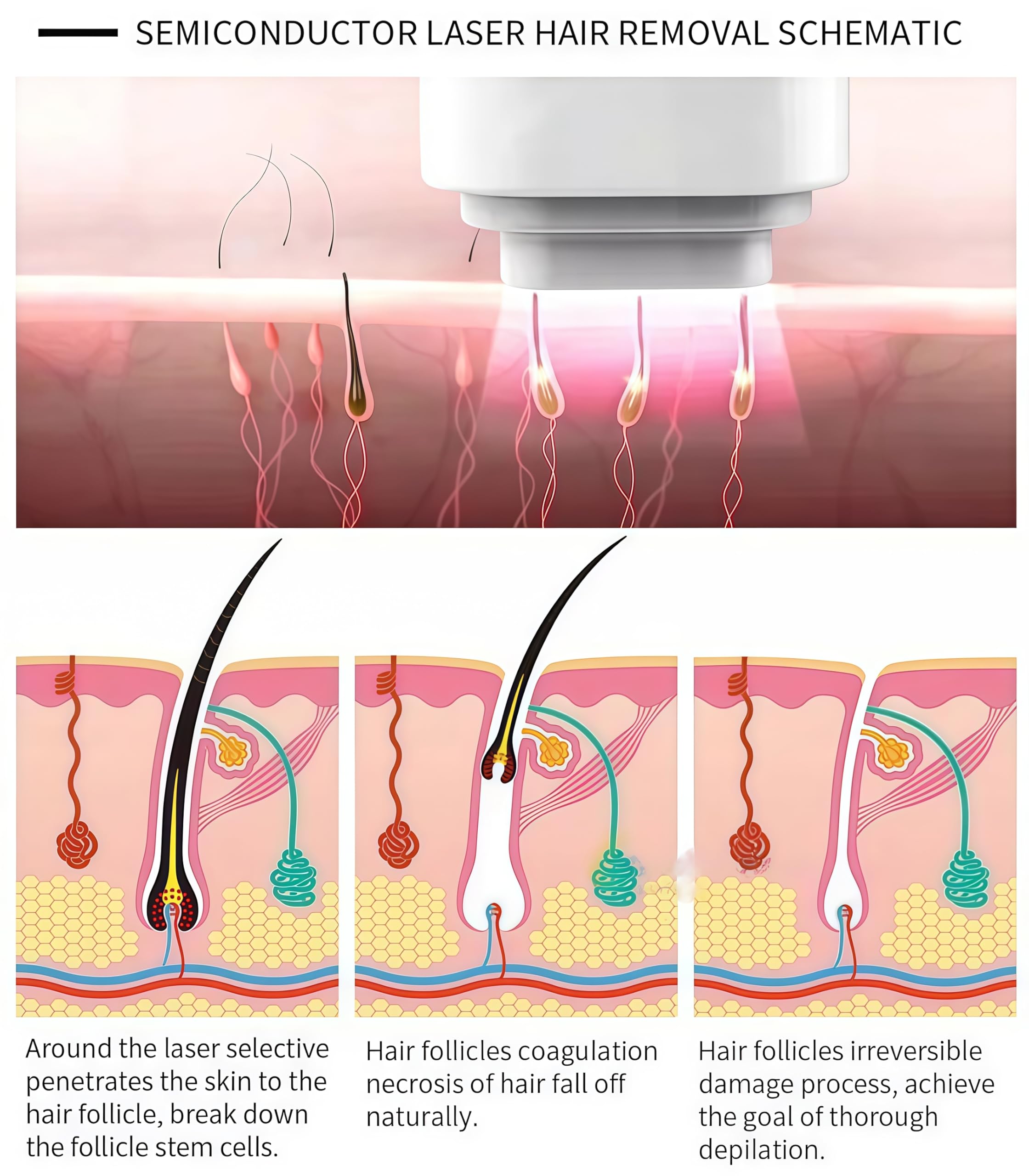 Apparecchio professionale per la depilazione laser a diodo da 4000 W, con 4 lunghezze d'onda (755, 808, 940,1064nm) per una depilazione intelligente e un'impugnatura ghiacciata per lenire la pelle
