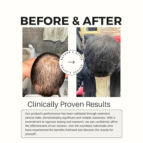 Miniatura 7 de Spray para el crecimiento del cabello para adelgazar el cabello, tratamiento de crecimiento del cabello para mujeres y hombres con aceite de ricino,