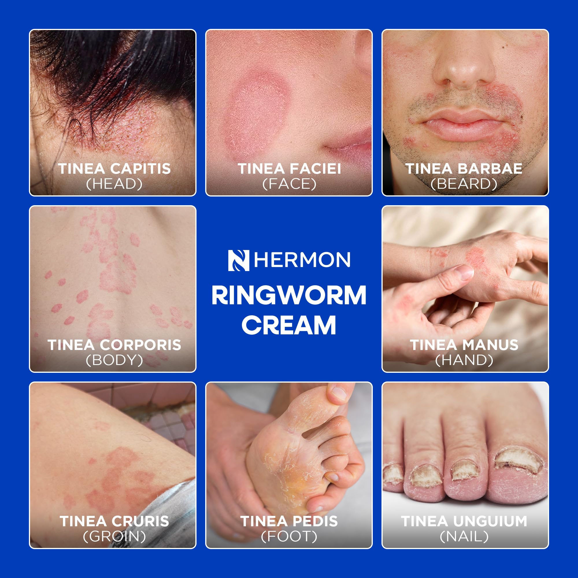 Hermon Antifungal Ringworm Cream for Humans – Helps Relieve Itching, Redness & Discomfort from Ringworm, Jock Itch, Athlete’s Foot & Tinea Versicolor – Gentle for Adults & Kids – 100ml — Amazon image 5