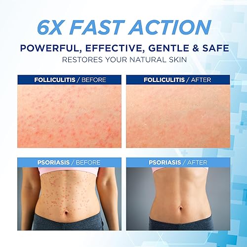 Miniatura 2 de Crema Tratamiento de Foliculitis Tratamiento Eficaz para Foliculitis Cuero Cabelludo Cara y Cuerpo 3.53 oz