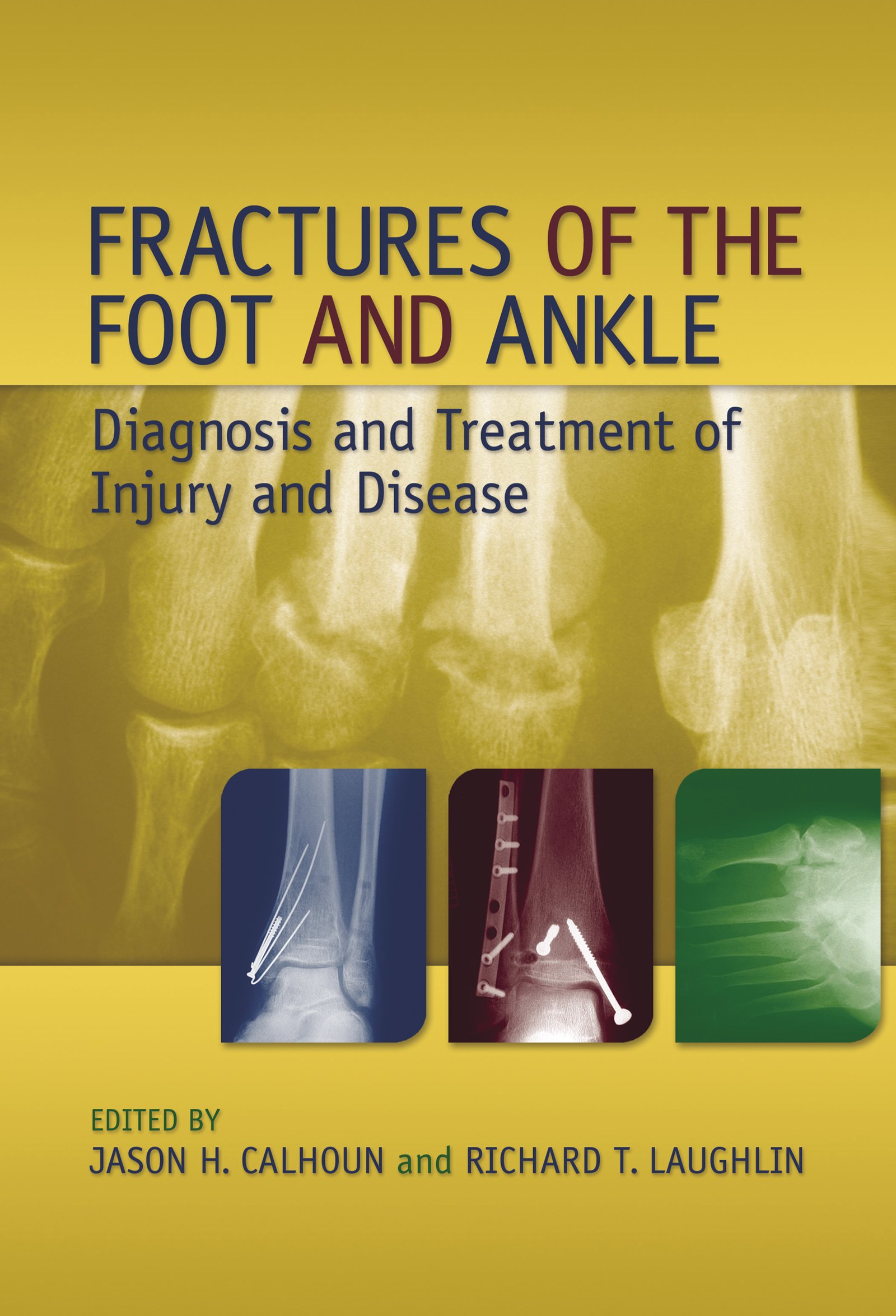 Fractures of the Foot and Ankle: Diagnosis and Treatment of Injury and Disease