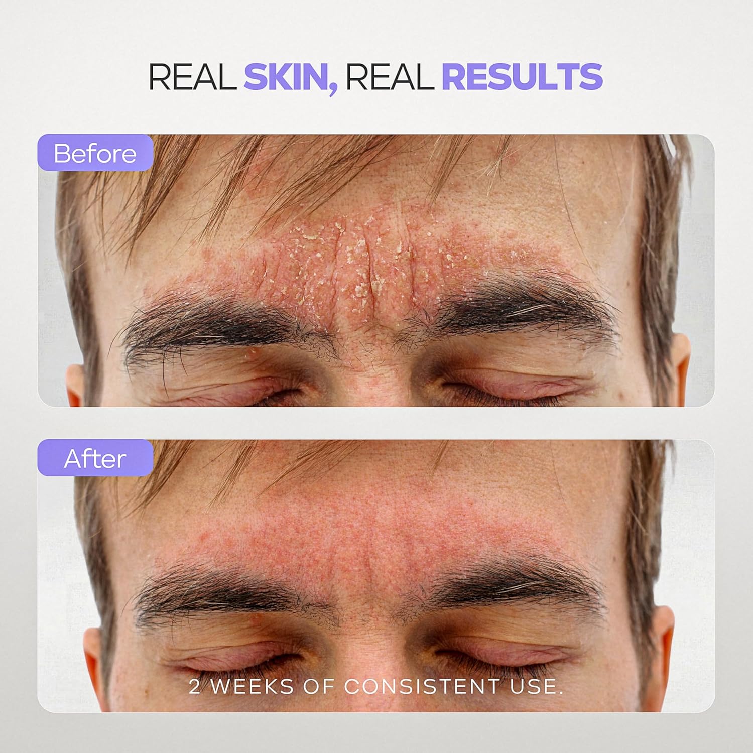 DERMAdoctor Seborrheic Dermatitis Shampoo – 2% Pyrithione Zinc Face Wash, Dermatologist Formulated Anti Dandruff Shampoo for Women, Itchy Scalp Treatment for Hair, Beard, Face & Body – 7.10 oz - Image 8