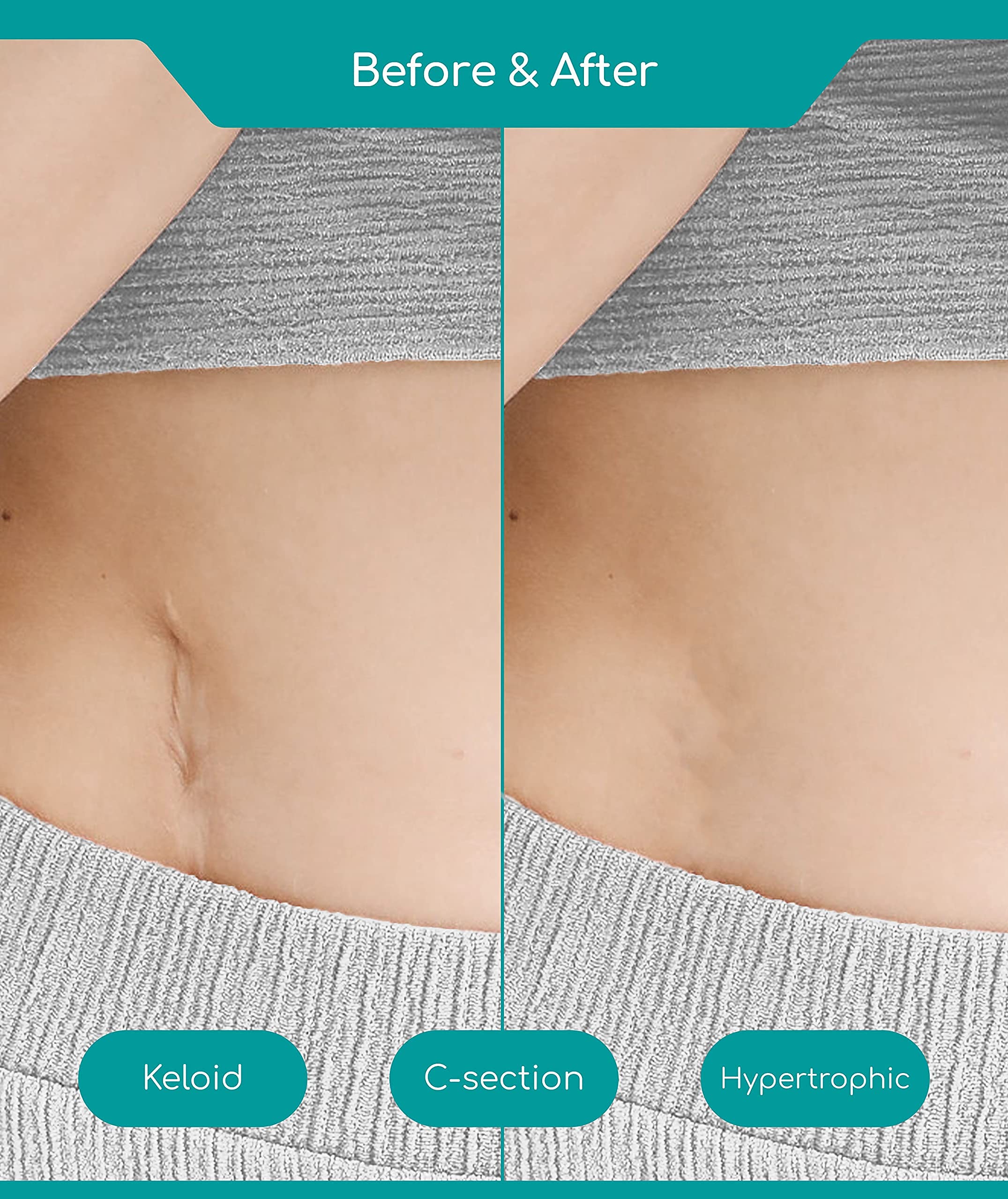 Silicone Scar Roll [2 Meters], Medi Grade Reusable Scar Removal Sheets