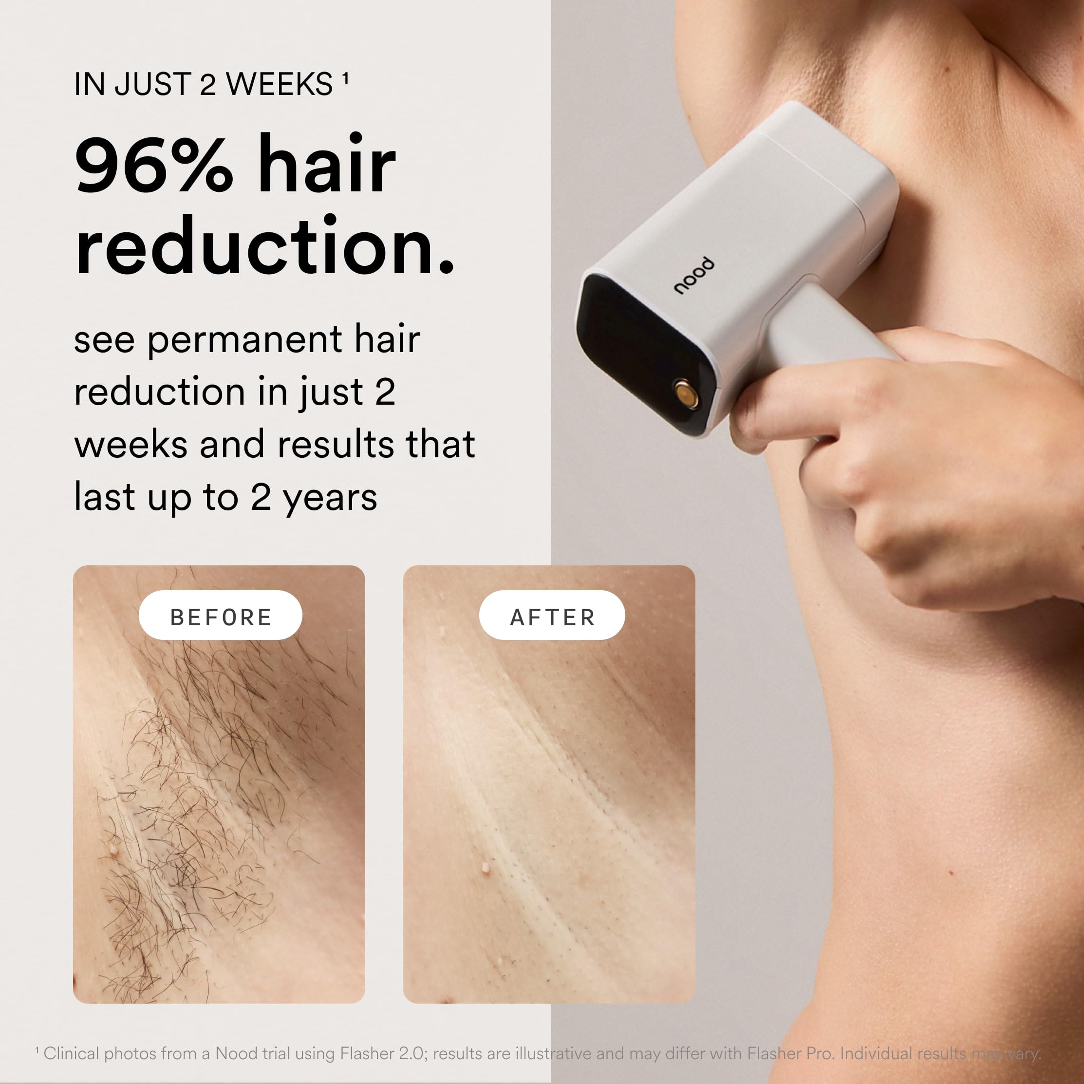 NEW Nood™ Flasher Pro — IPL Laser Hair Removal Device for Women & Men with Sapphire Cooling — Pain-free & Permanent, Visible Results After First Use & Works Everywhere Hair Grows — Gloss White