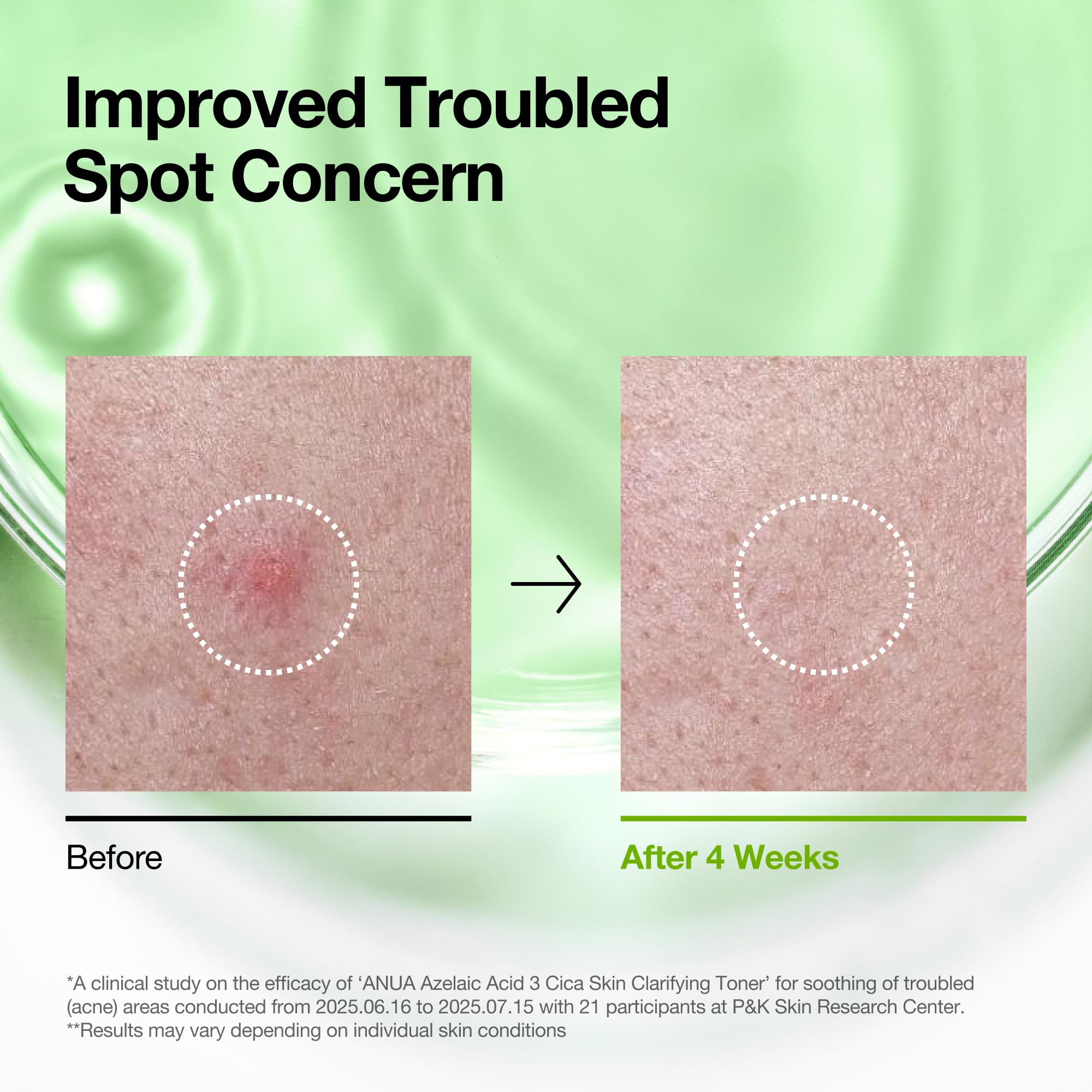 Anua Azelaic Acid 3 CICA Skin Claryfing, tonifiant et transparent, avec acide salicylique et acide azélaïque, sébum & Spot Care, convient aux peaux sensibles, soins de la peau coréenne (250 ml)