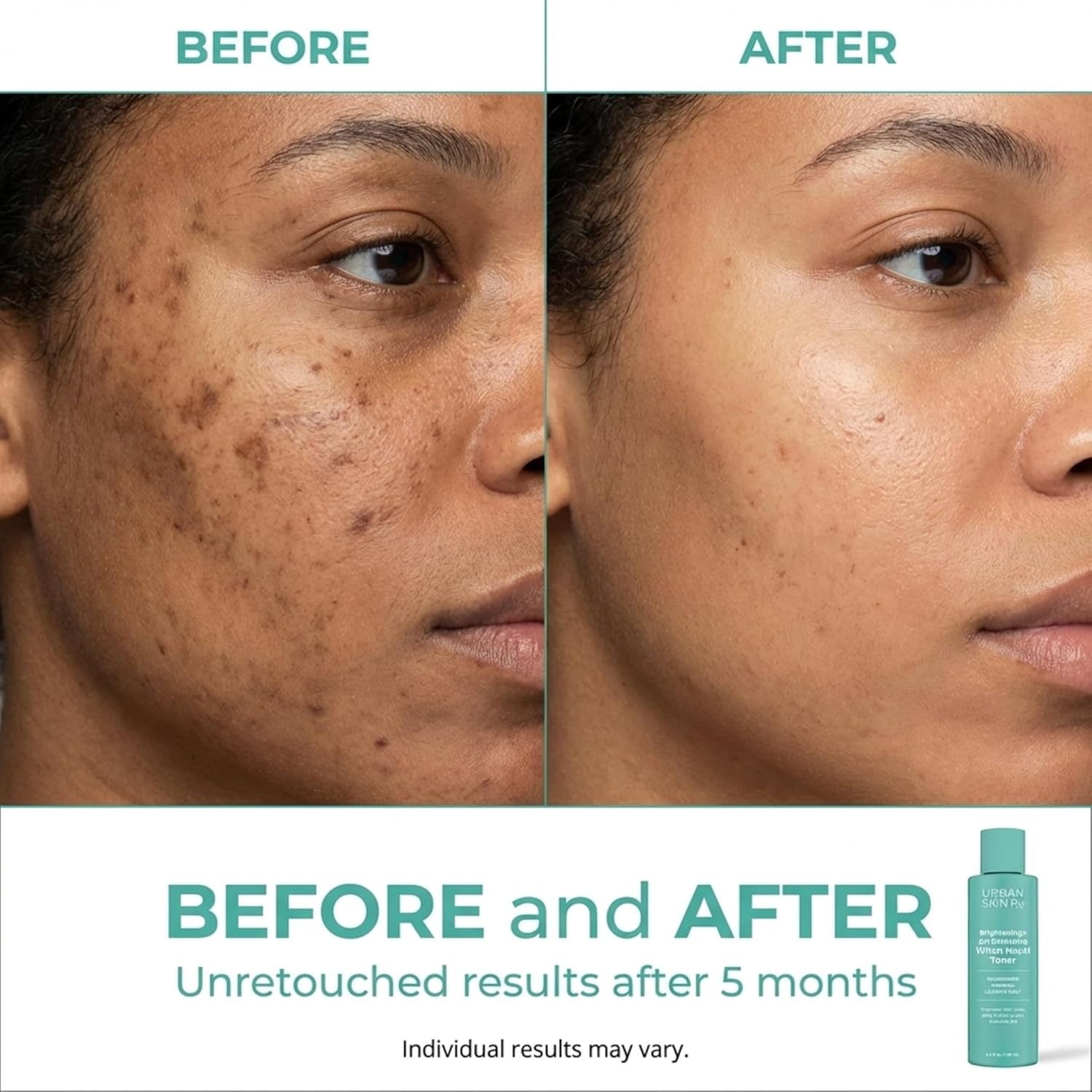 Urban Skin Rx Witch Hazel Brightening & pH Balancing Toner, Exfoliated & Clarifies Clogged Pores, Improves the Appearance of Uneven Skin Tone, Reduces Redness & Brightens Dull Complexions, 4.5 Fl Oz