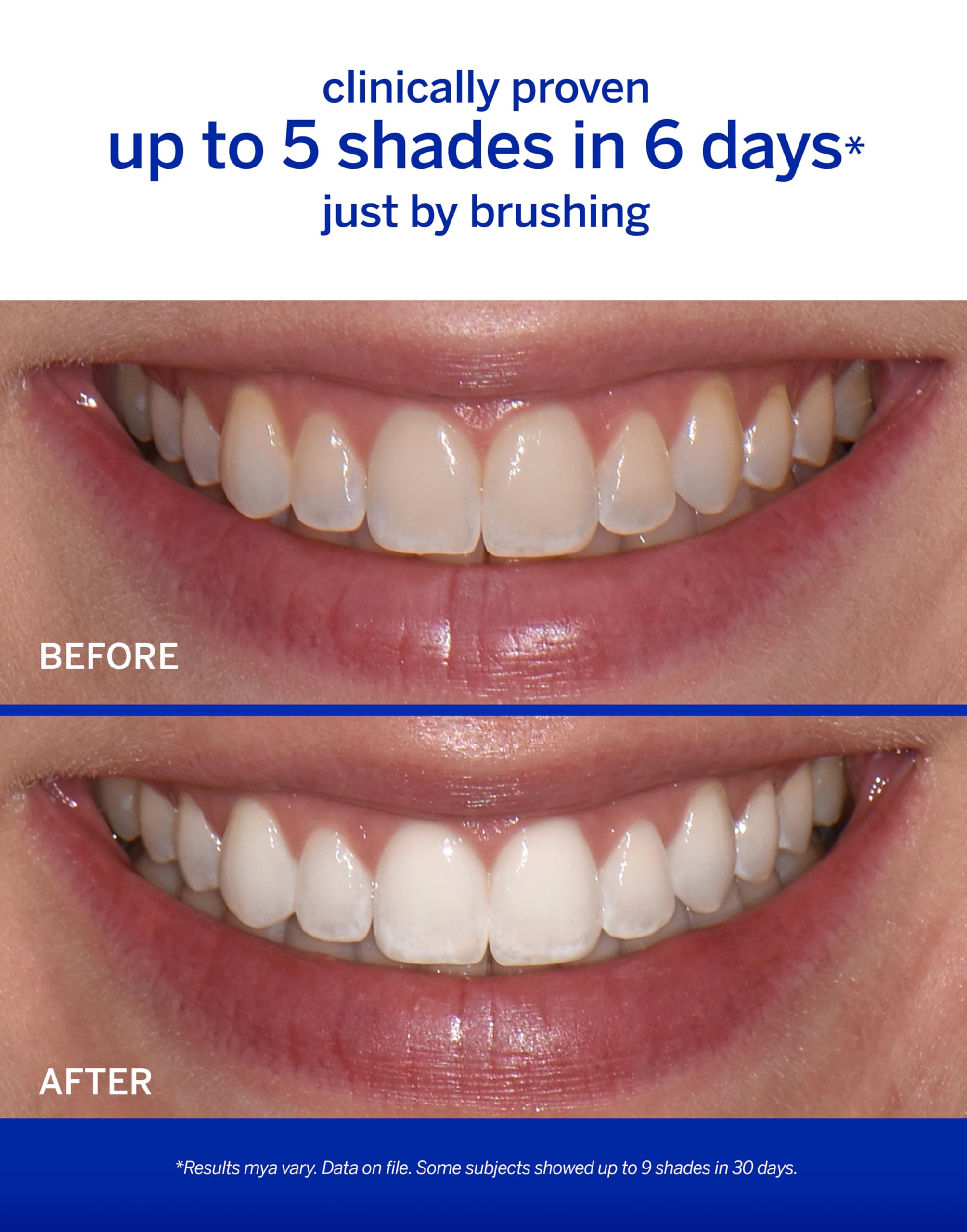 Supersmile The Works – Professional Whitening Toothpaste and Accelerator Duo – Whitens Up to 6 Shades