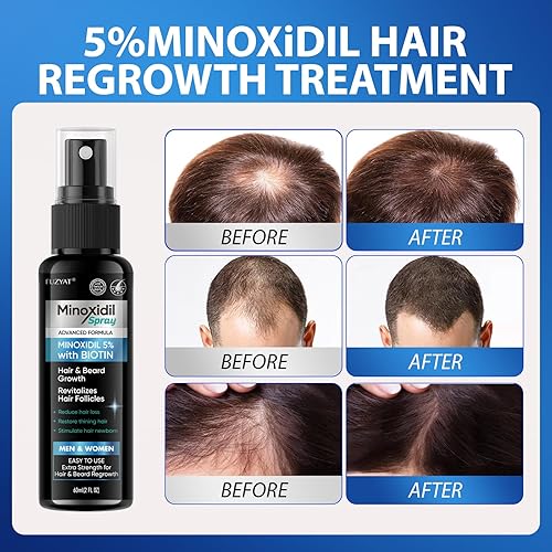 Miniatura 3 de Minoxidil al 5% para tratamiento de pérdida de cabello para hombres, minoxidil para mujeres, aerosol para el crecimiento del cabello, para hombres y