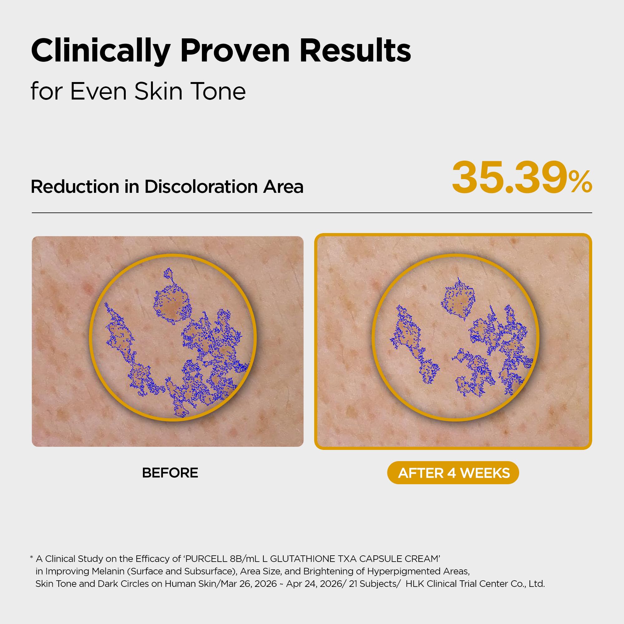 glutathione good for psoriasis PURCELL TXA Capsule Cream with 5% Tranexamic Acid + 5% Niacinamide – L-Glutathione Antioxidant Moisturizer Even-Toned Skin, Reduces Dullness & Uneven Skin Tone, All Skin Types (2.71 fl oz Cherry Flavor Strenght:1000mg TERRA ELMNT 2150mg Liposomal