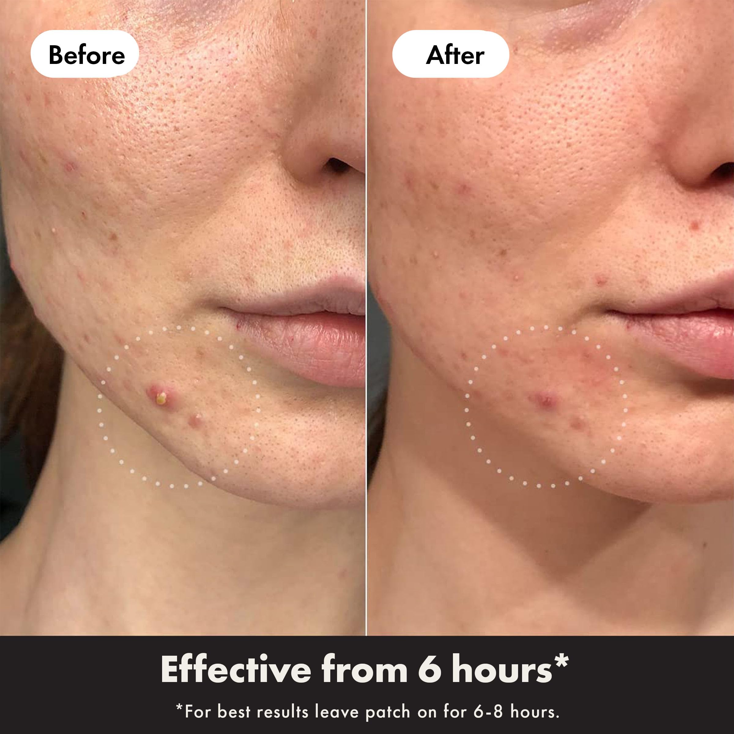 Hero Cosmetics Mighty Patch Day + Night, Hydrocolloid Acne Patches, Absorb gunk from Spots Within 6 Hours - Image 4