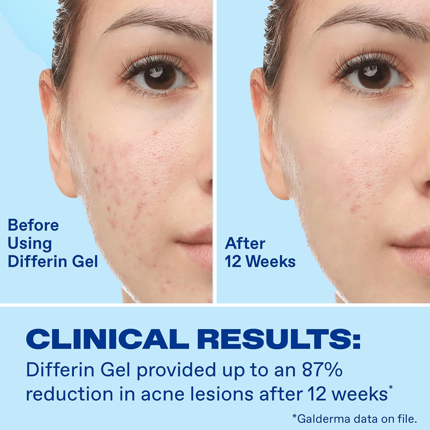 Differin Acne Kit, Retinoid Treatment Gel + Pimple Patches, 15g